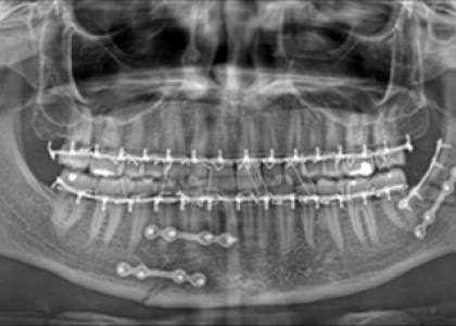 Hopital befelatanana
